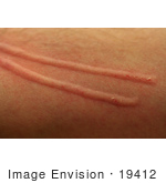 19412-stock-photo-of-a-mans-skin-on-his-arm-raised-after-a-cat-scratch-by-jamie-voetsch.jpg
