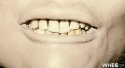 Irondequoit Jane Doe_teeth.jpg