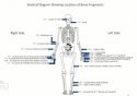 Dr Rogers Diagram of Bone Fragments Found.jpg