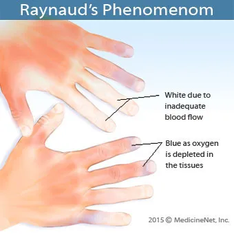 raynauds-phenomenon-s1a-what-is-raynauds.jpg